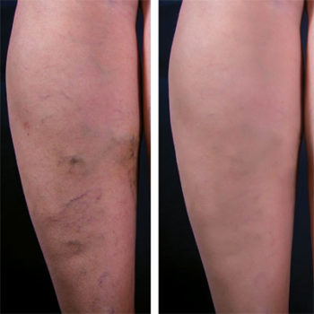 Varicose Veins - POM Vascular