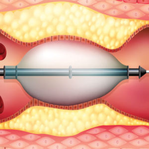 Peripheral Artery Disease - POM Vascular